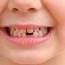 2-18 насны хүүхдүүдийн шүдийг эмчилнэ